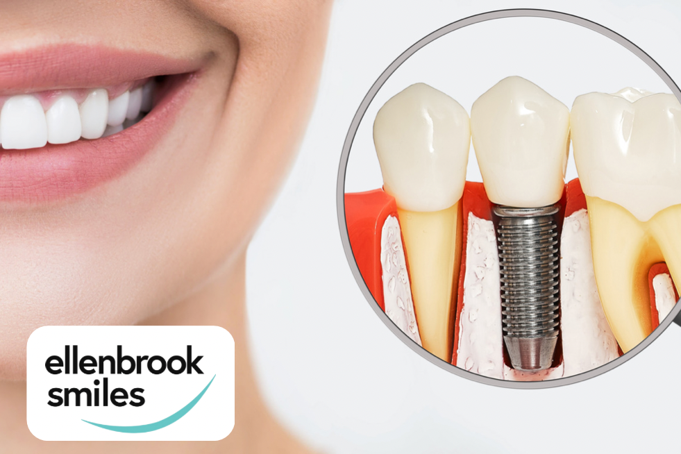 5 Reasons Why Dental Implants Are The Best Choice To Replace Your Teeth